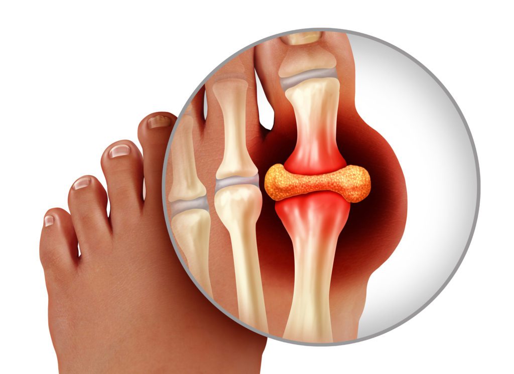 Gout Causes How To Get The Best Health Outcomes ZOOM Pharmacy