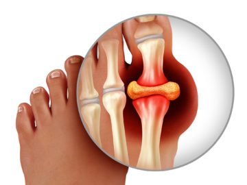 Gout Causes: How To Get The Best Health Outcomes