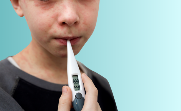 Measles: Symptoms, Treatment & Prevention - Zoom Pharmacy