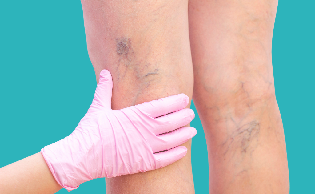 A healthcare worker examining varicose veins on a leg.