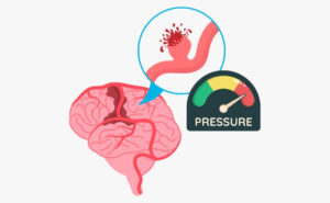 High blood pressure, hypertension and stroke NZ