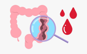 Colon cancer in nz, colon cancer symptoms, colon cancer risks