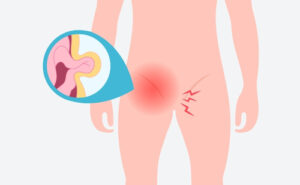 Reducing Your Risk of Hernia