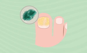 Fungal nail infection