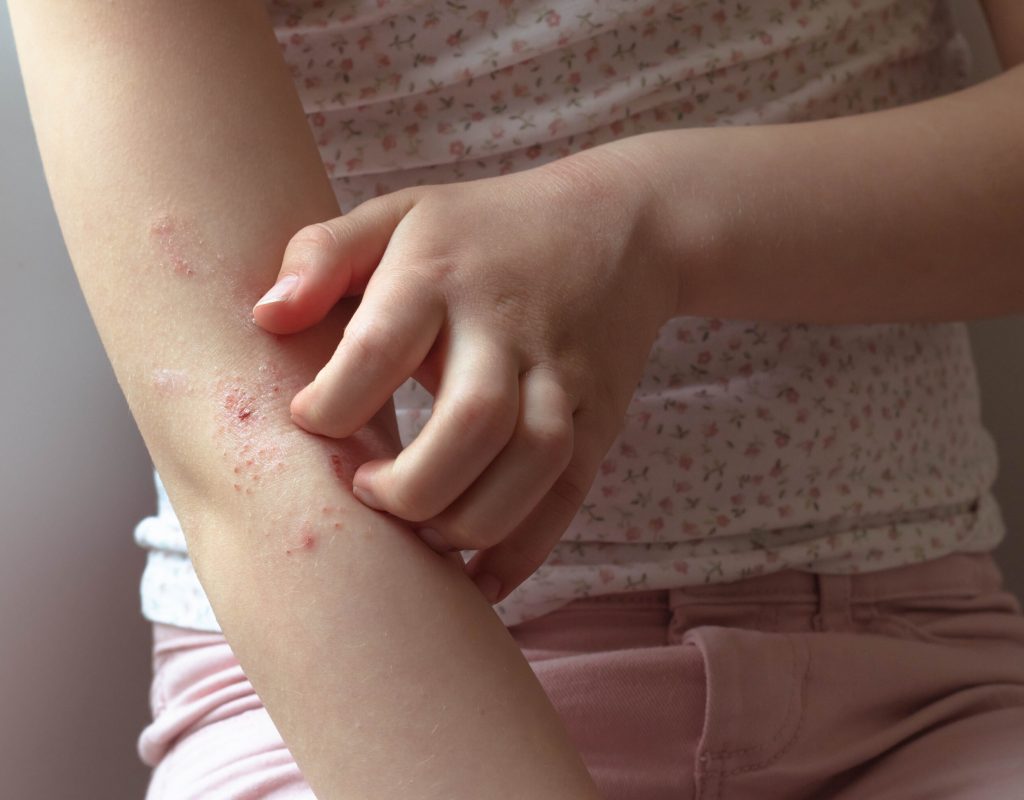 Eczema on right arm, left hand scratching the skin. Girl is wearing a white sleeveless top with flowers and pink pants.