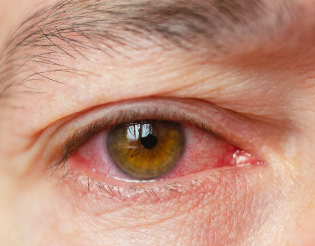 Closeup irritated infected red bloodshot eyes, conjunctivitis.