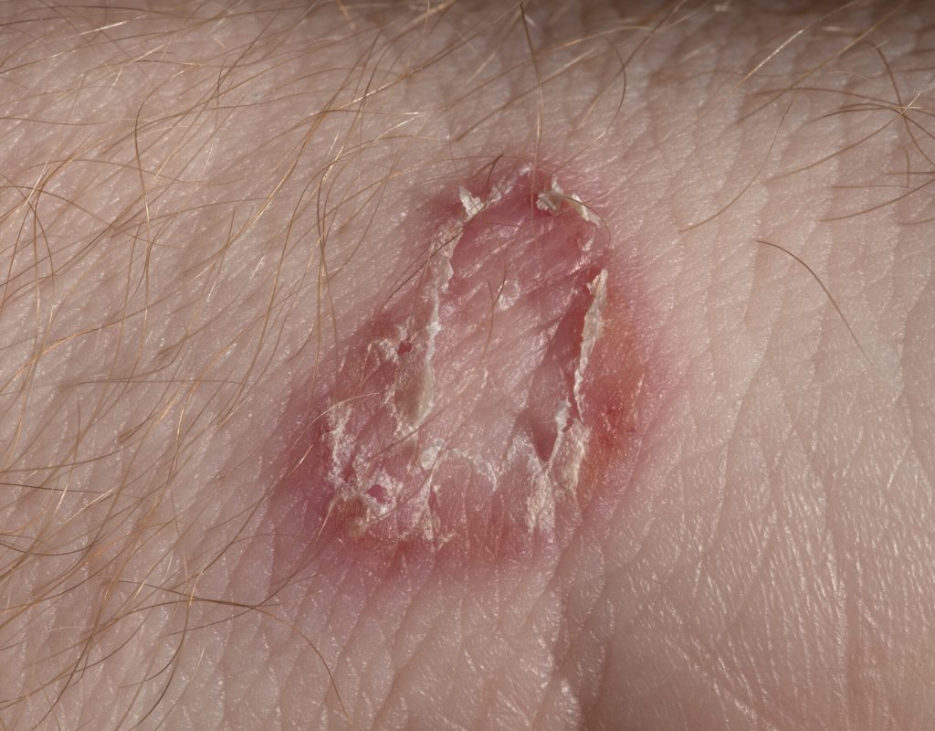 Ringworm on white man skin / Fungus Infection / Mycosis