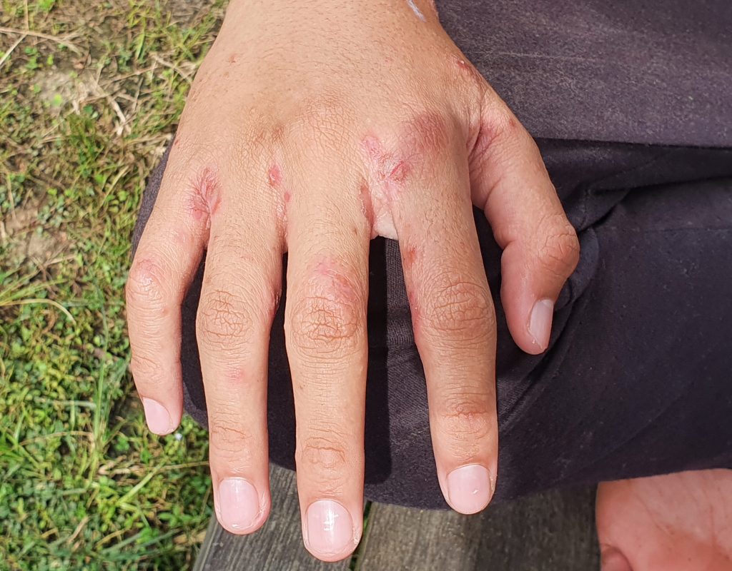 Close up of hand with with ulcer filled with pus condition caused of scabies infection, sensitive skin itchy health problem